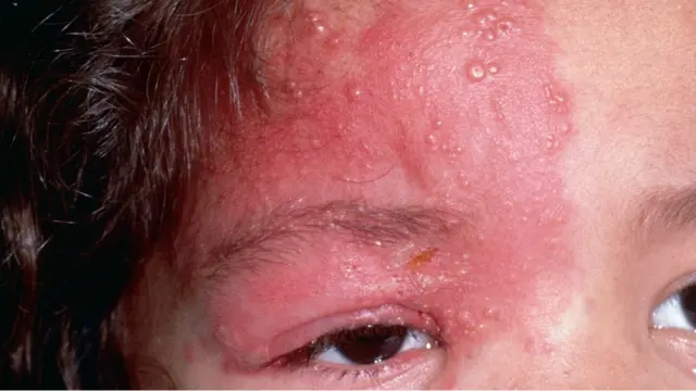 హెర్పెస్ జోస్టర్ లేక షింగిల్స్