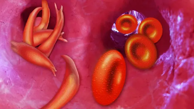 Серповидные клетки и нормальные эритроциты