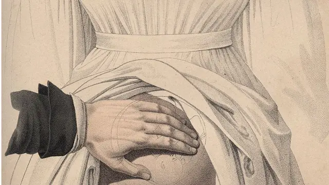 इग्नाज सेमेल्विस