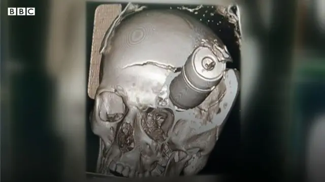 ภาพซีทีสแกน