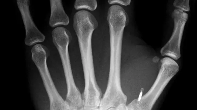 Рентгеновский снимок левой руки Марка Гассона, на котором виден маленький микрочип