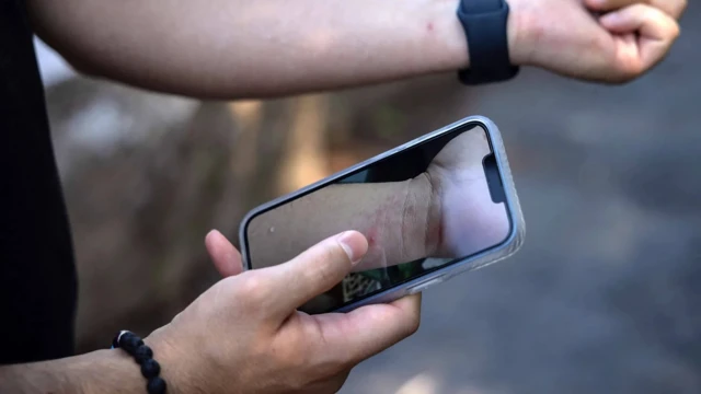 팔에 남은 엠폭스 흉터