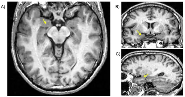 Localización de la amígdala en imágenes de resonancia magnética estructural (mostrada por las flechas amarillas). A) corte axial; B) corte coronal y C) corte sagital.