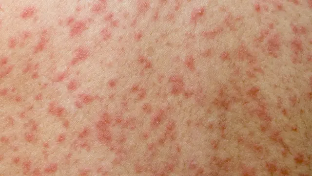 Osip kod obolele osobe