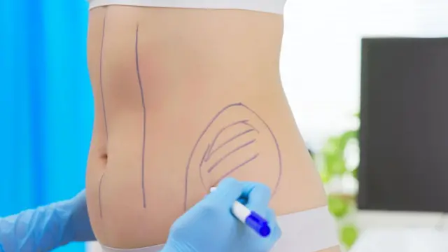 抽脂手術