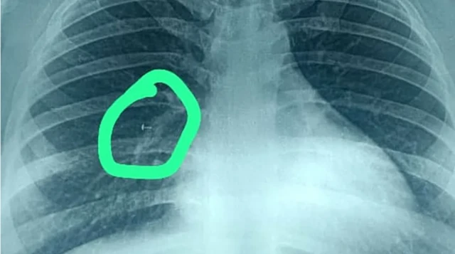 நுரையீரலில் சிக்கிக்கொண்ட மூக்குத்தி திருகு