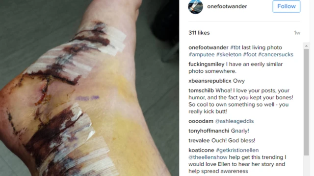 Awali mguu huo ulipofanyiwa upasuaji, lakini sasa umesababisha gumzo mtandaoni