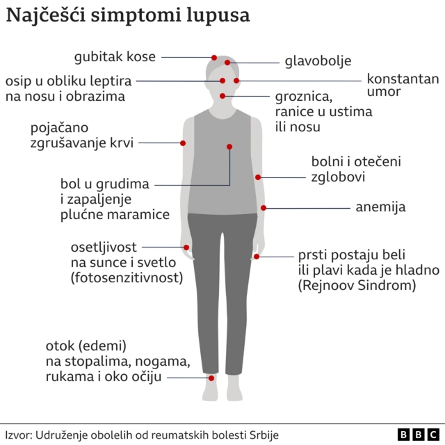 Srbija i zdravlje: Šta je lupus i kako se leči - BBC News na srpskom