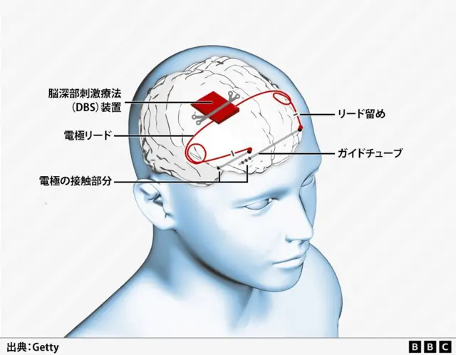 てんかん発作抑える装置、頭蓋骨に埋め込み 世界初の臨床試験に