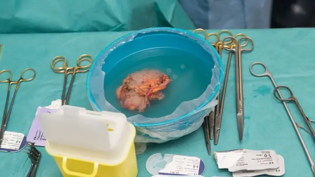 உடல் உறுப்பு தானம்