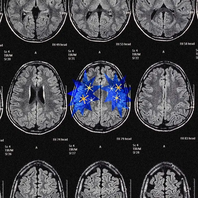 Serie de imágenes de resonancia magnética cerebral con figuras estrelladas azules superpuestas en la región central del cerebro.