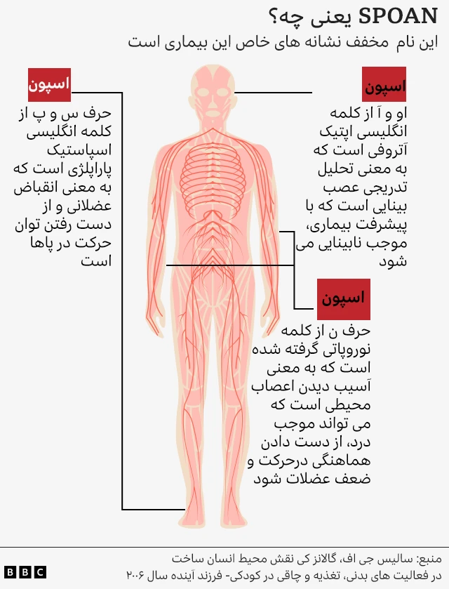 گرافیک از یک بدن با علائم سندرم اسپون