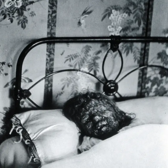 Niña con viruela 1896