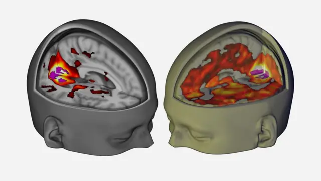This image shows how, with eyes closed, much of more of the brain contributes to the visual experience under LSD (right) than under placebo (left)