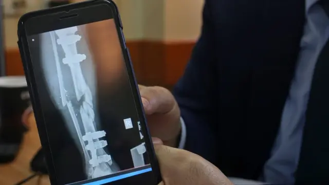 طبيب فلسطيني في مستشفى الشفاء يعرض أشعة مقطعية تظهر التهتك والكسر الذي حدس في عظام أحد المصابين.