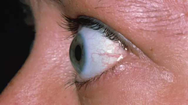 Exophthalmos