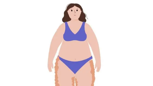 লাইপেডিমা