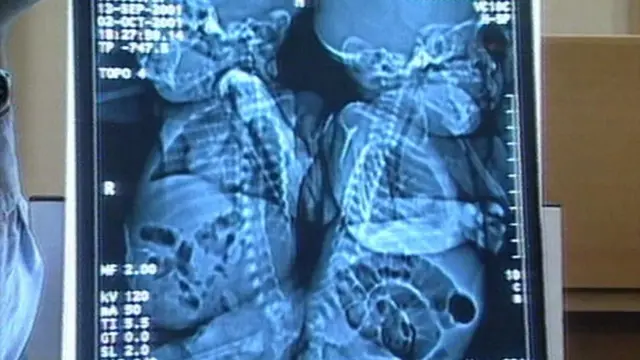 సయామీ కవలలుగా సంచియా, ఎమాన్ మోవాట్ ఎక్స్రే