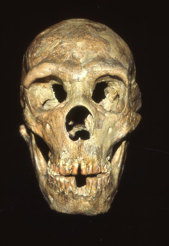 Crânio de neandertal apresentando sinais de violenta pancada na região da bochecha e olho esquerdos