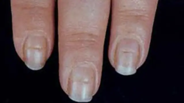 Uñas con líneas de Beau.