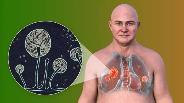 ਕਿਲਰ ਫੰਗਸ