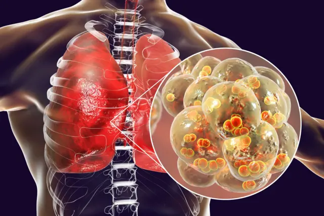 Illustration de pneumonie