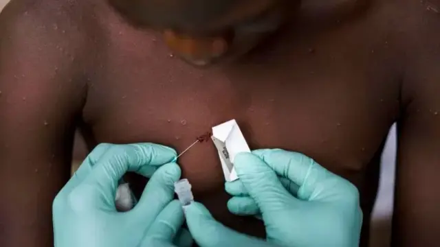 मंकीपॉक्स