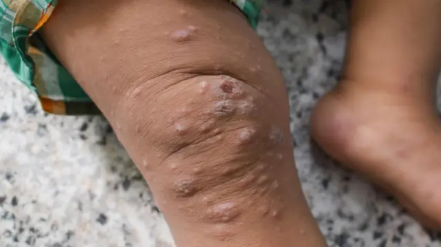 Nwata bu ọrị mpox
