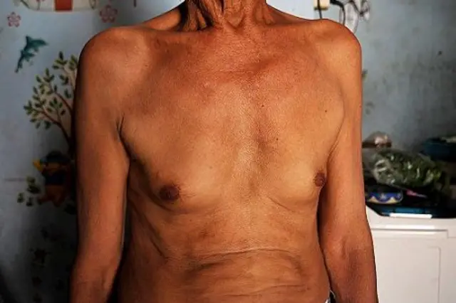 Slamet (68) penderita TBC, terlihat di rumahnya usai pemeriksaan kesehatan di Klinik Persatuan Indonesia Melawan Tuberkulosis (PPTI).