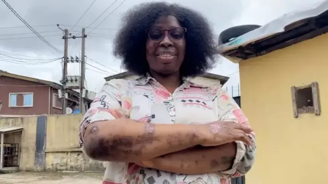 Àmì àpẹẹrẹ lupus