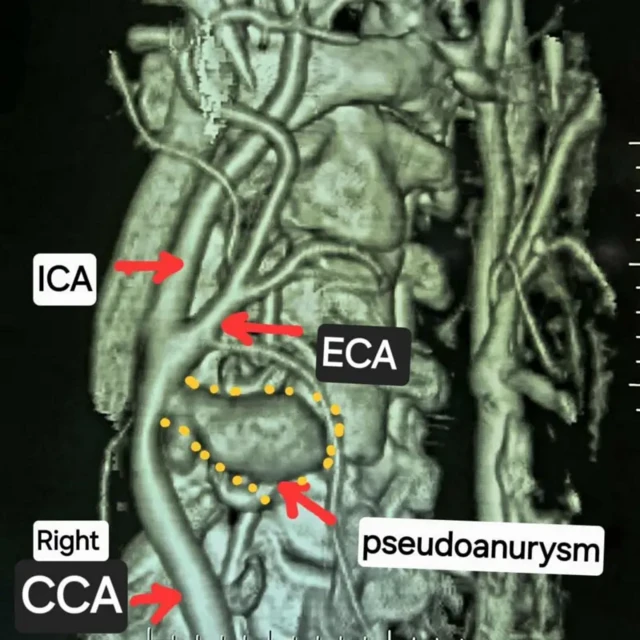 گردن کی شریان