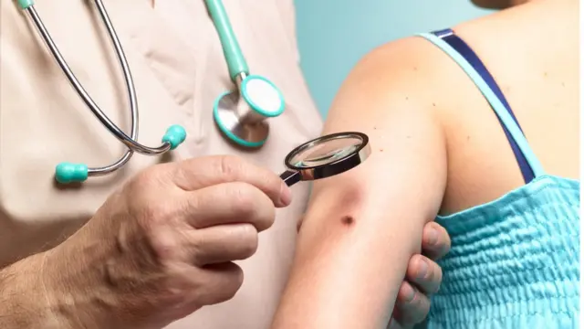 स्किन कैंसर