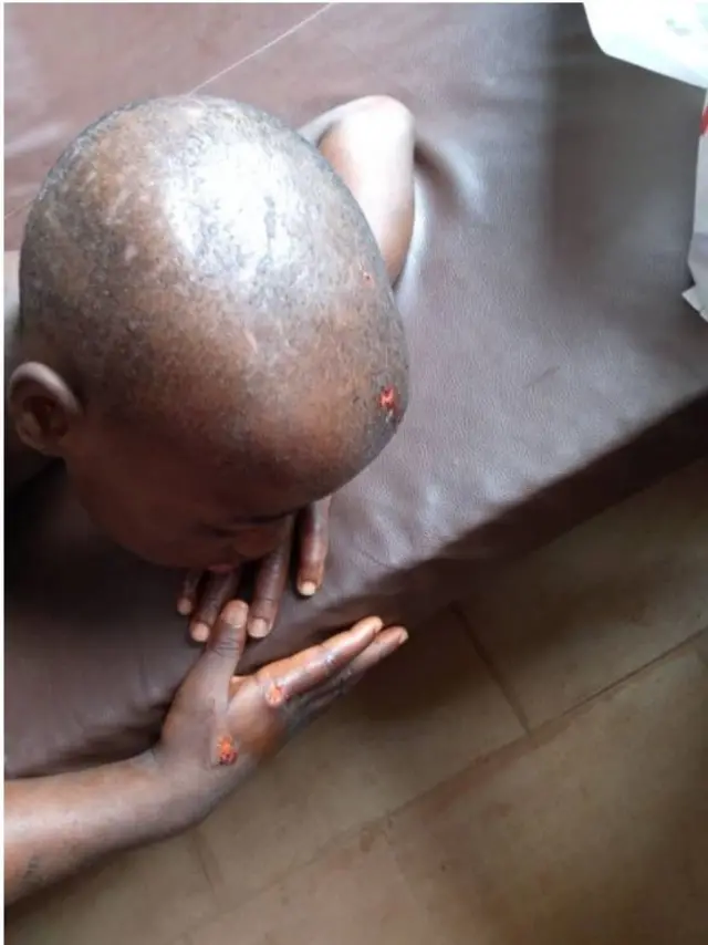 Nwata a kụrụ ntu n'isi