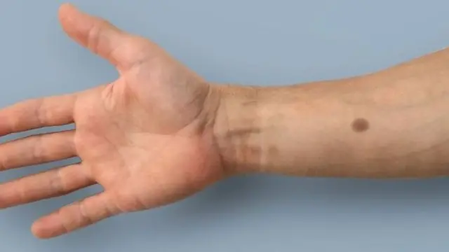 人工痣