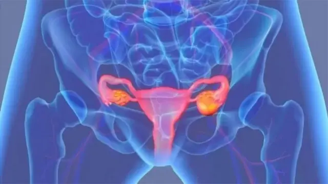 गर्भाशय गाठी