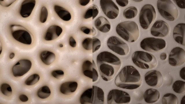 Differences in bone density - higher on the left, lower on the right