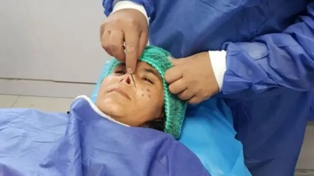 عمل جراحی زرقا با بیهوشی موضعی انجام شد