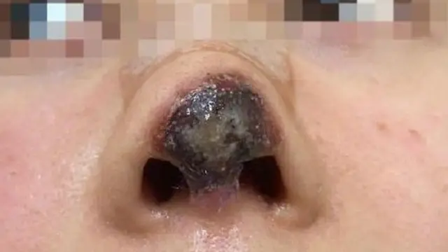 Plastic surgery: Chinese actress Gao Liu necrosis