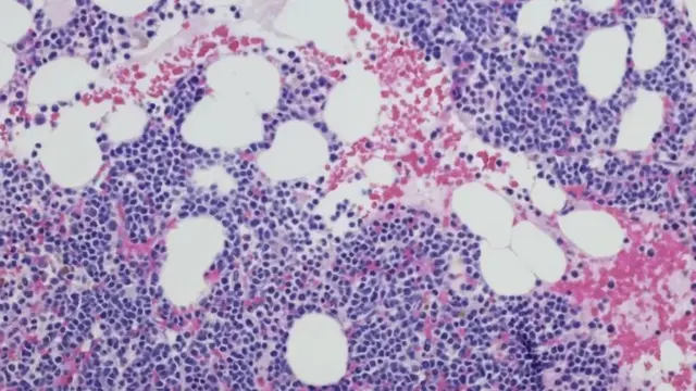 ਮਲਟੀਪਲ ਮਾਈਲੋਮਾ