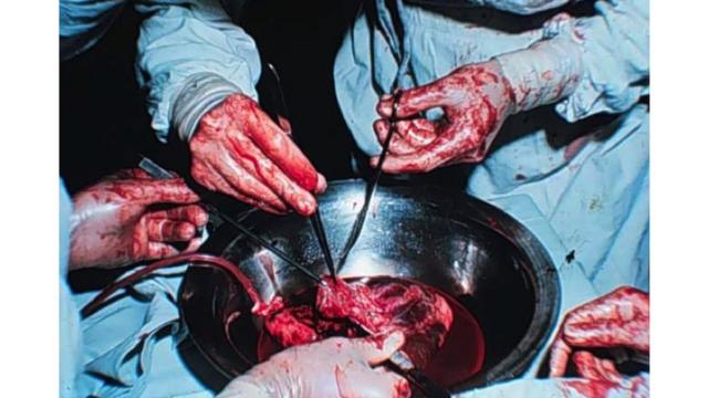 Transplante cardíacoapostar na mega sena pelo aplicativo da caixaJoão Ferreira da Cunha