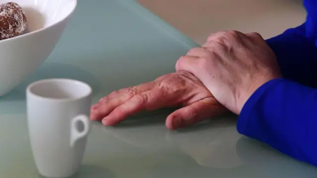 Kerutan jari yang tidak simetris, di mana satu tangan lebih sedikit keriput daripada tangan lainnya, meskipun lama perendaman sama—diduga sebagai tanda awal penyakit parkinson.