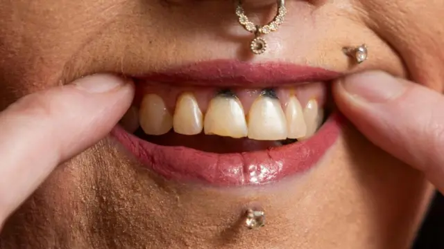 صورة مكبرة لأسنان ستايسي