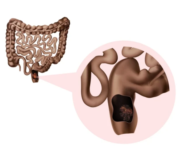 ਬਵਾਸੀਰ ਅਤੇ ਗੁਦਾ ਦੇ ਕੈਂਸਰ ਵਿੱਚ ਅੰਤਰ