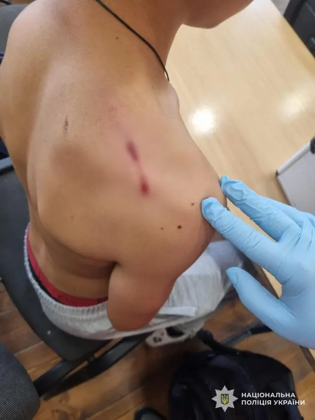 Один із учнів класу отримав невелике поранення, його здоровʼю нічого не загрожує 