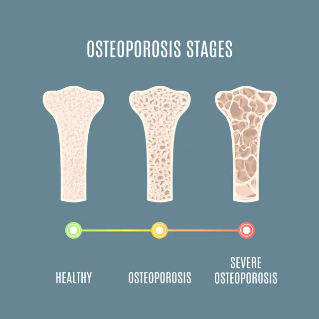 osteoporosis - ஆஸ்டியோபோரோசிஸ்