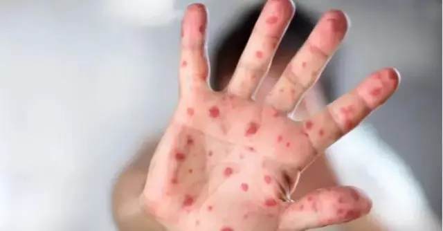 Calaamada Tomato flu