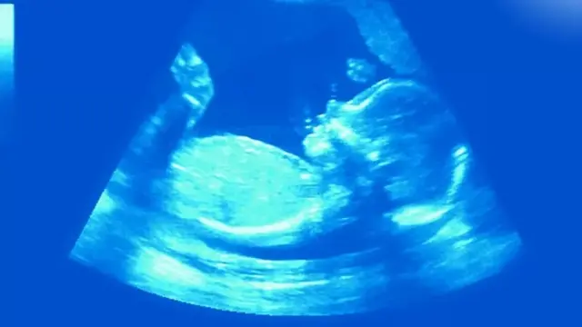 ہچکی اور علاج