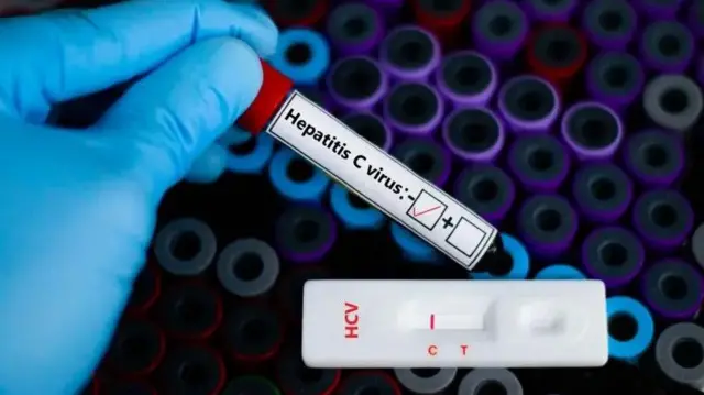 हेपेटाइटिस बी या सी वायरस से लिवर कैंसर हो सकता है.