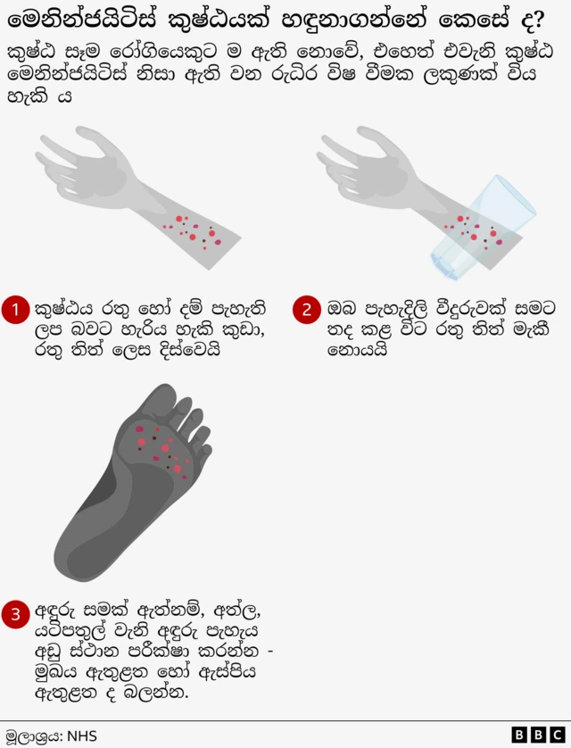 මෙනින්ජයිටිස් 