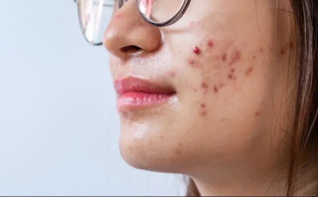 ખીલ, ચહેરા પરની ખીલ, ખીલનાં લક્ષણો, ખીલની સારવાર, બીબીસી ગુજરાતી
